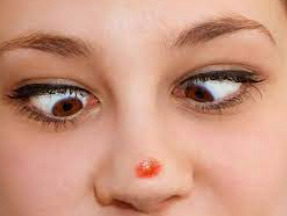 What causes acne on the nose?